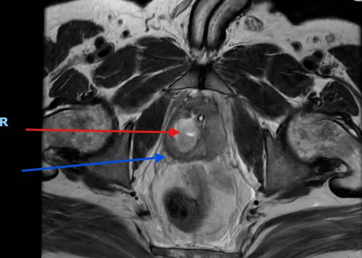 T2-weighted MRI of the prostate, axial view: abscess marked with a red arrow and extension outside the prostate with a blue arrow